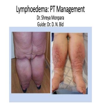 Lymphoedema - Physiotherapy Management