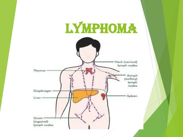 Lymphoma in children Dr G.Rajkumar | PPTX