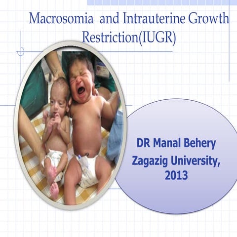 Macrosomia and iugr with case study for undergraduare