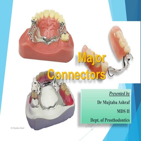 Major connector In prosthodontics
