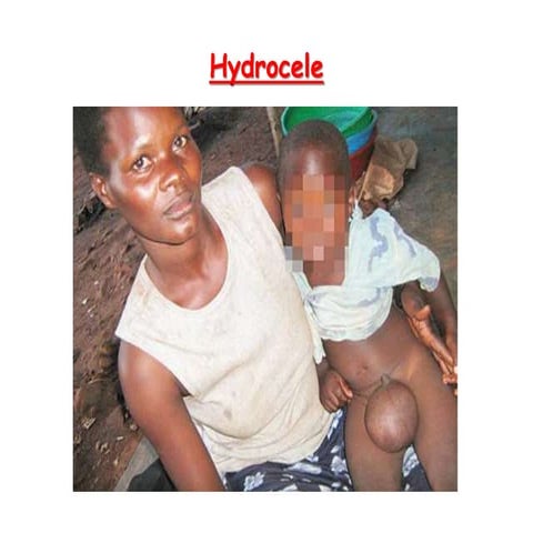 Hydrocele and testicular tumor