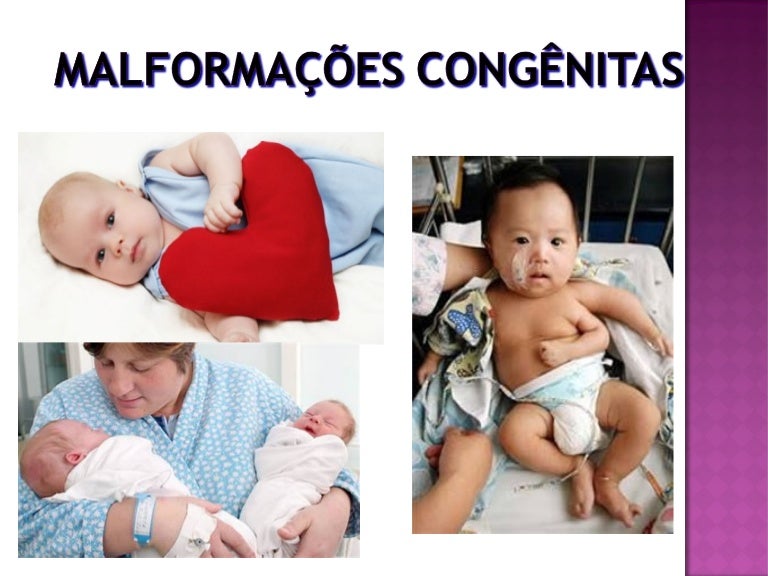 Malformações Congênitas