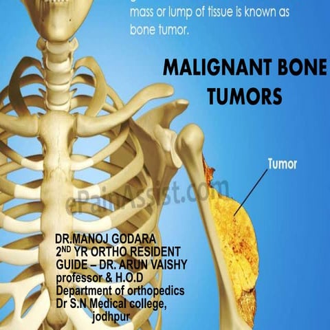 What Is A Malignant Tumor Of A Bone Called? – WDDC