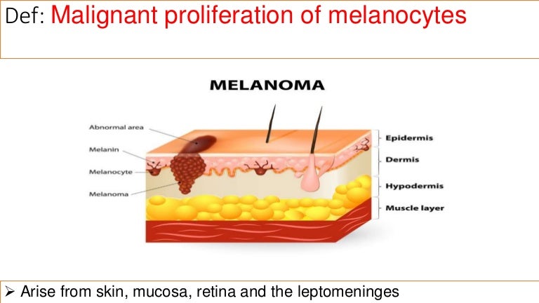 Malignant Melanoma