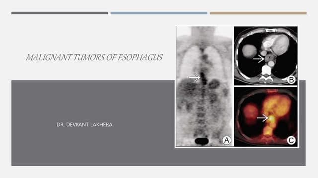 Malignant tumors of esophagus