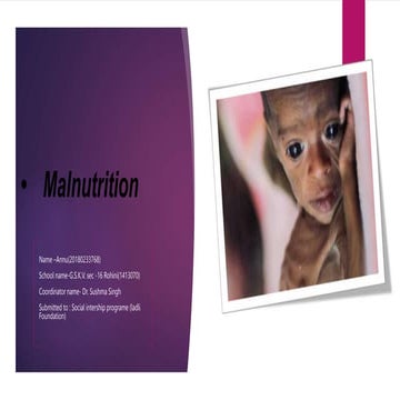 Malnutrition and Micronutrients Deficiency | PPTX