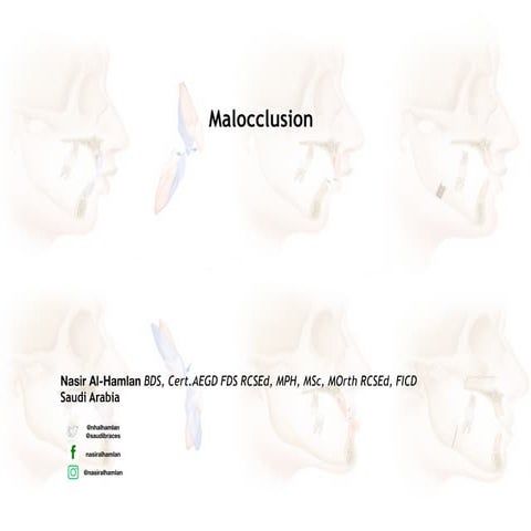 Maloccluison