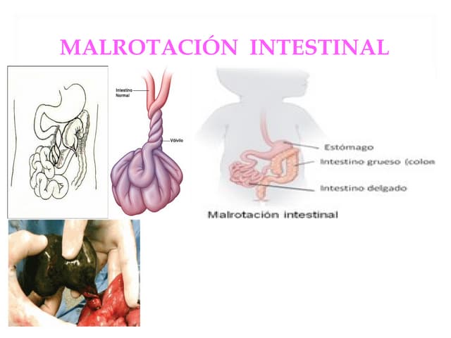 Malrotacion intestinal cirugia pediatrica