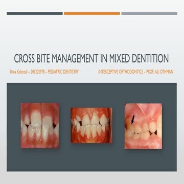 Management of crossbite in mixed dentition