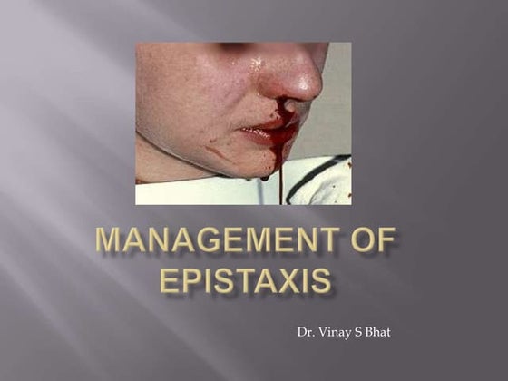 Epistaxis | PPT