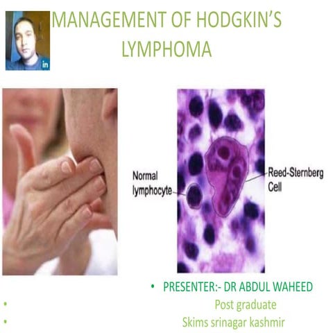 Management of hodgkin lymphoma.pptx123