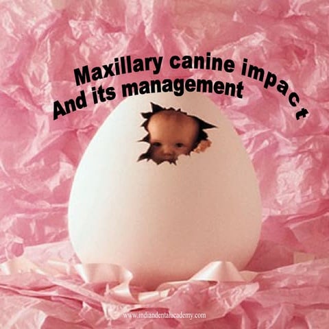 Management of impacted canine (2)