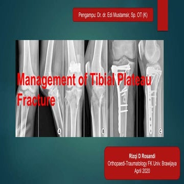 Management of tibial plateau fracture