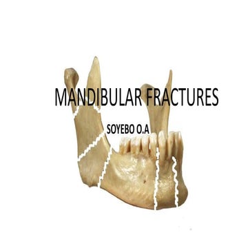 Mandibular fracture