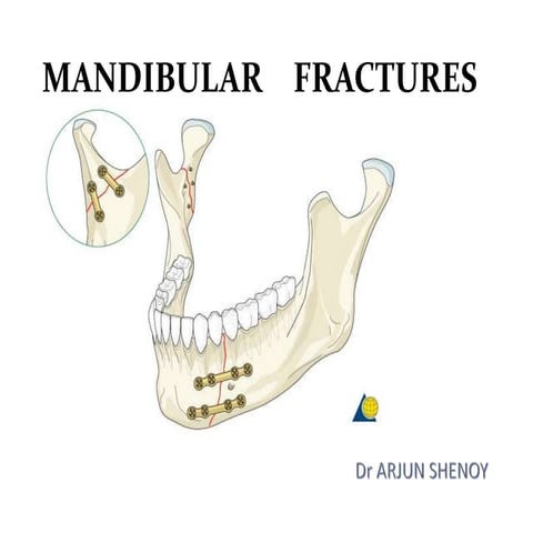Mandibular fractures