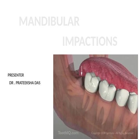 MANDIBULAR IMPACTION ,EVIDENCED BASED PPT