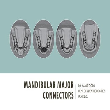 Mandibular Major Connectors