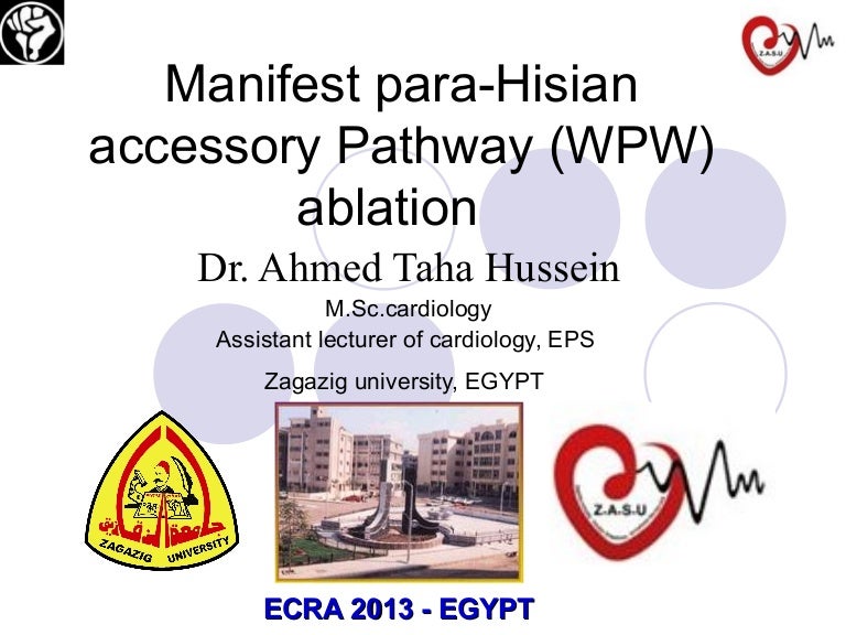 Manifest paraHisian accessory pathway (wpw) ablation our experience