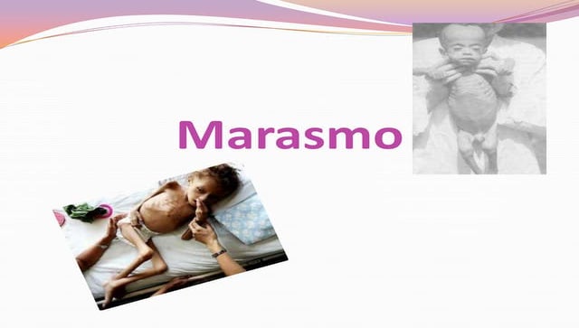 Kwashiorkor marasmo | PPT