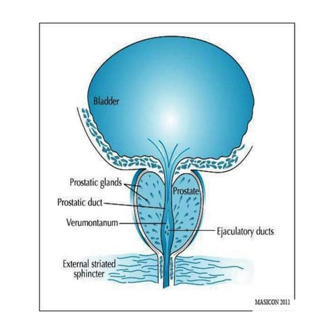 Transurethral resection of the prostate (TURP) | PPTX