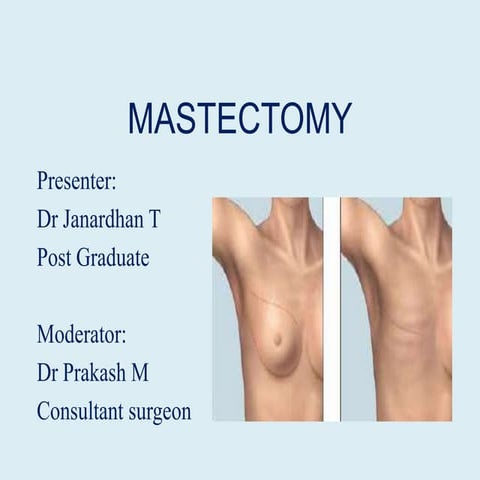 Mastectomy