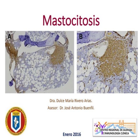 Mastocitosis