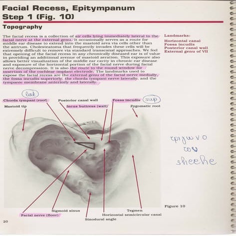 Mastoidectomy Epitympanum