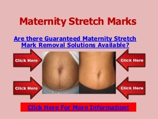 Maternity stretch marks