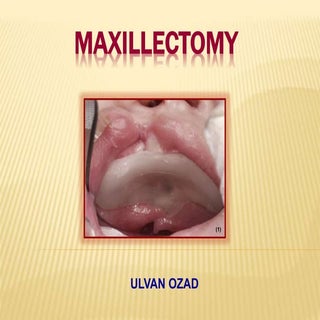 Maxillectomy