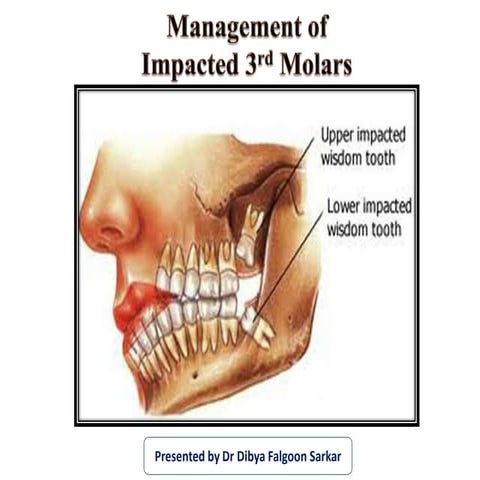 Management of Impacted Third Molars