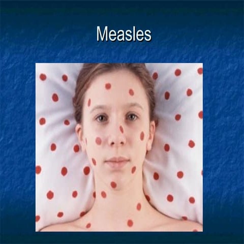 Measles