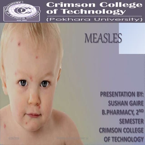 Measles