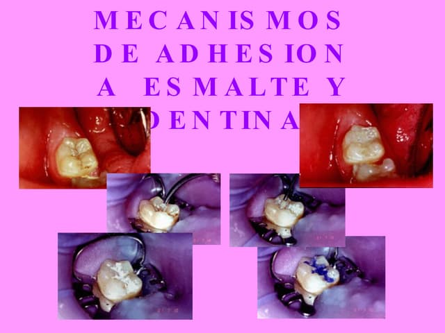 Mecanismos de adhesion a  esmalte y...