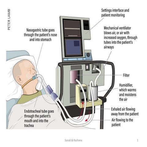 Mechanical Ventilation