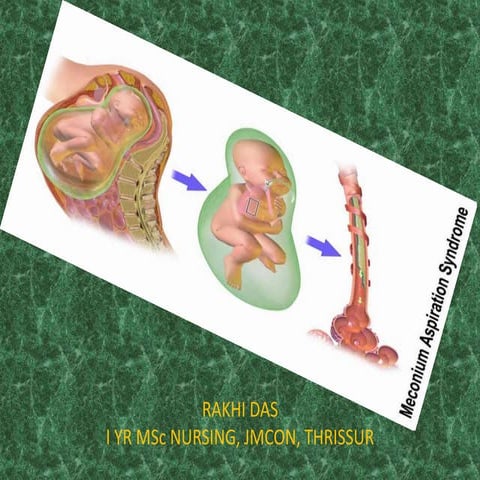 Meconium aspiration syndrome