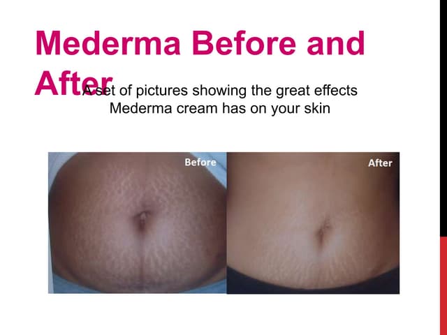 Does Mederma Work On Hyperpigmentation Mederma before-and-after | PPT