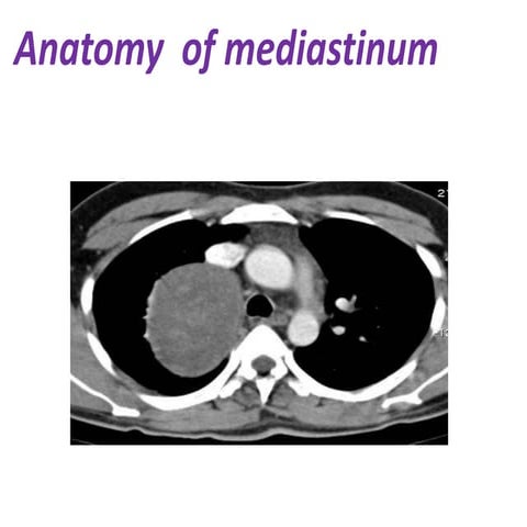 Mediastinal anatomy ,classification of mediastinal masses ans its localization