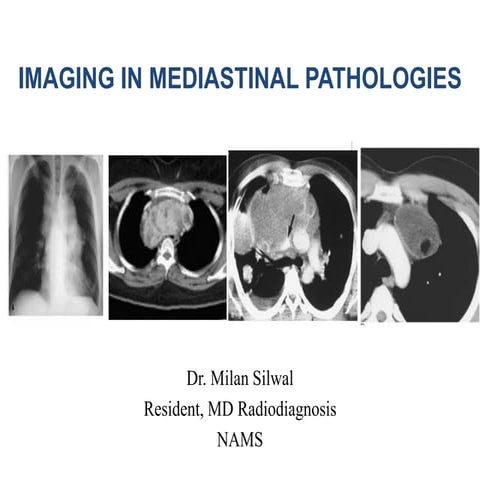 Imaging in mediastinal masses by Dr. Milan Silwal