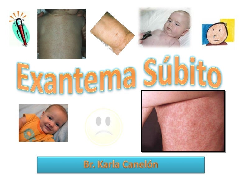 Pediatria Exantema Subito