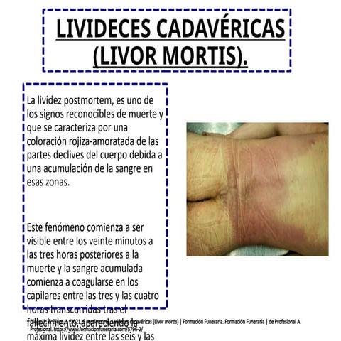 Medicina livideces cadavericad livor mortis | PPTX