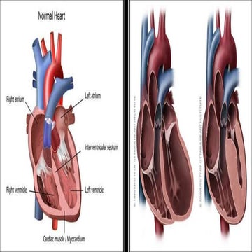 CARDIOMYOPATHY