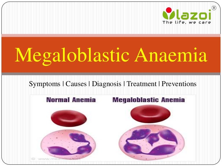 Megaloblastic Anaemia: Symptoms, causes, diagnosis ...