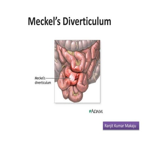 Mekel’s diverticulum