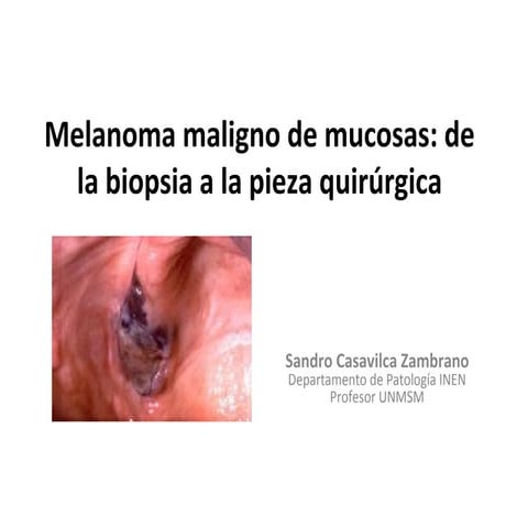 Melanoma maligno de mucosa oral