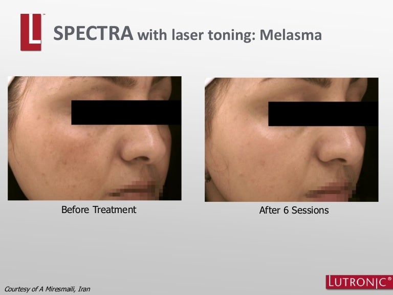 Melasma Results