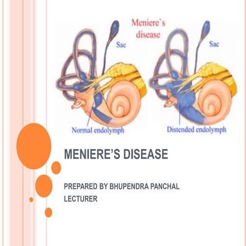 Meniere;s disease