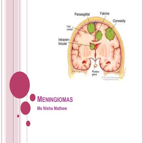 Meningioma