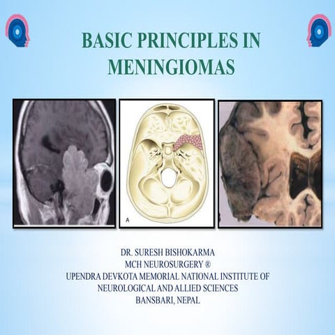 Meningioma of brain