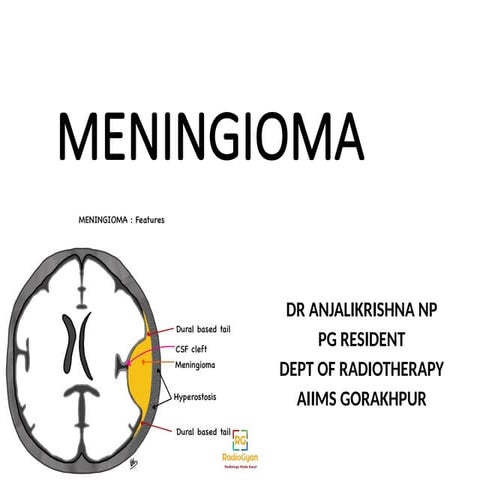 meningioma radiation oncology dept .pptx