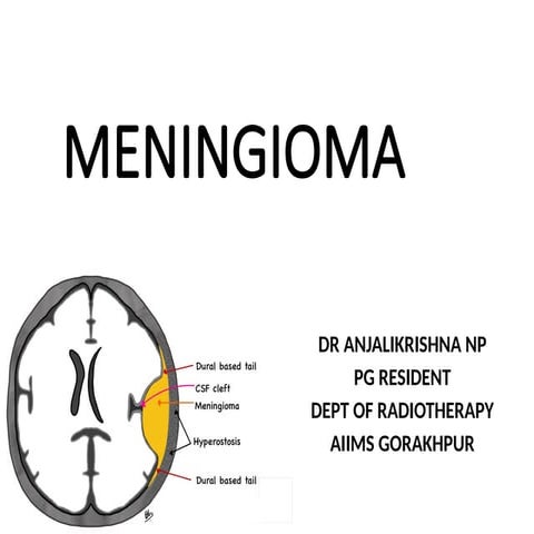meningiomafinal-170205140136 (3).pptx MENINGIOMA